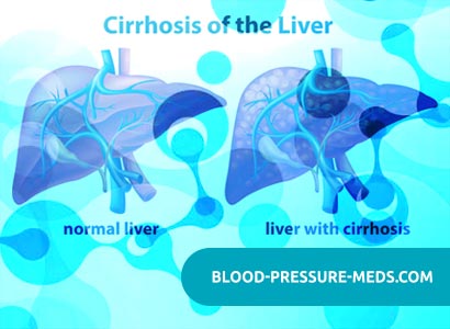 Liver Cirrhosis